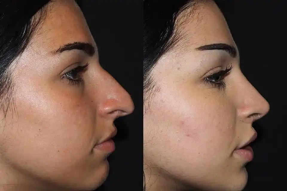 Top Qualities to Look for in the Best Rhinoplasty Surgeon in Dubai