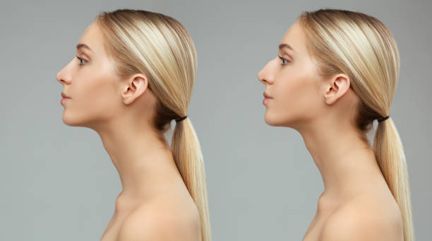 Rhinoplasty in Riyadh